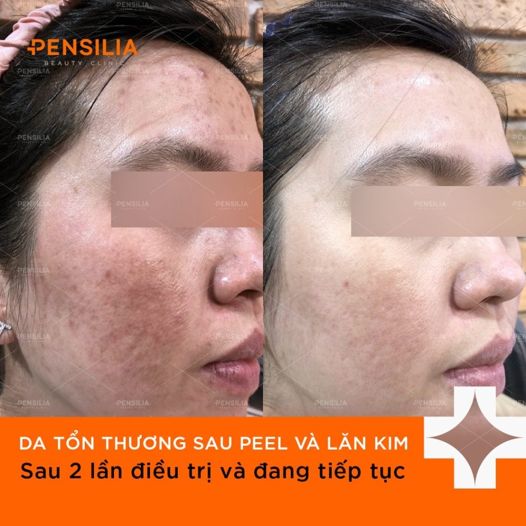 Trị Đỏ da và nám mạch máu