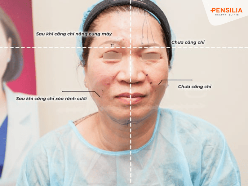 Căng da bằng chỉ tăng sinh collagen trẻ hóa toàn diện