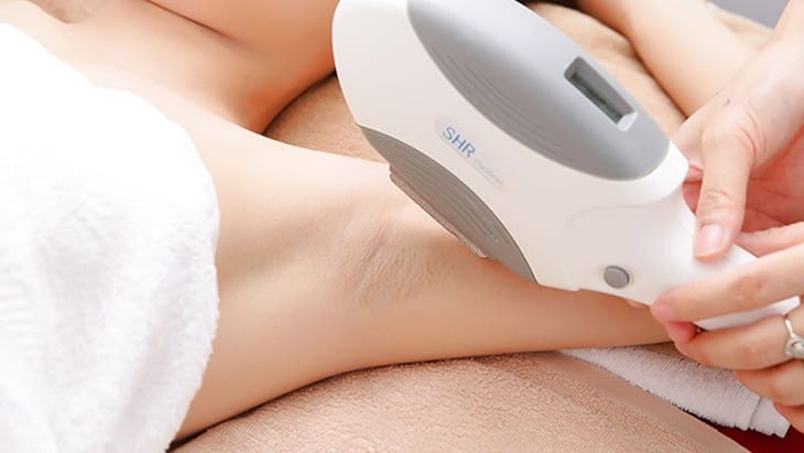 Triệt lông bằng công nghệ IPL 