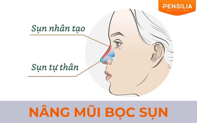 Nâng mũi bọc sụn là gì