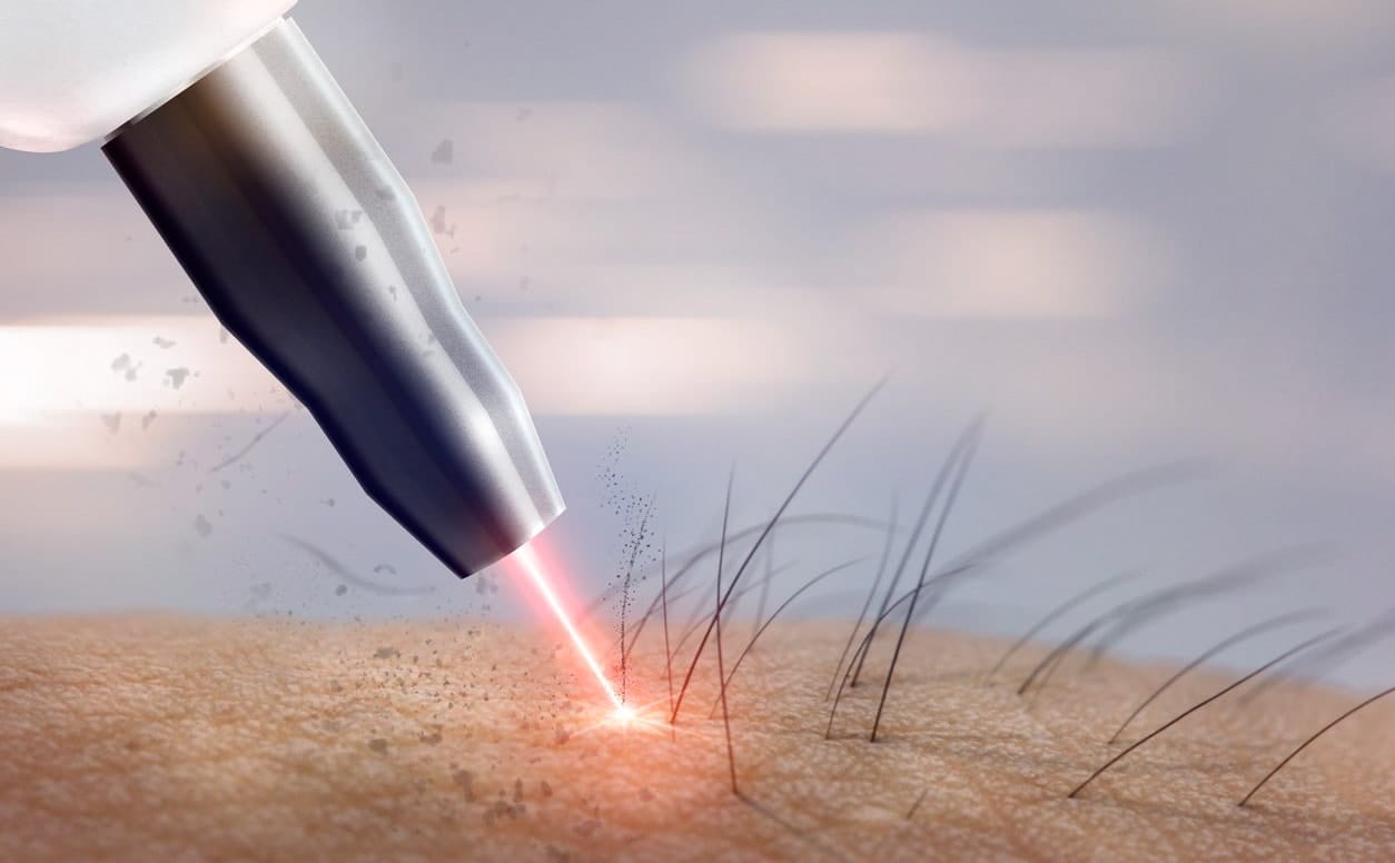 Laser diode đem đến hiệu quả trong triệt lông thẩm mỹ