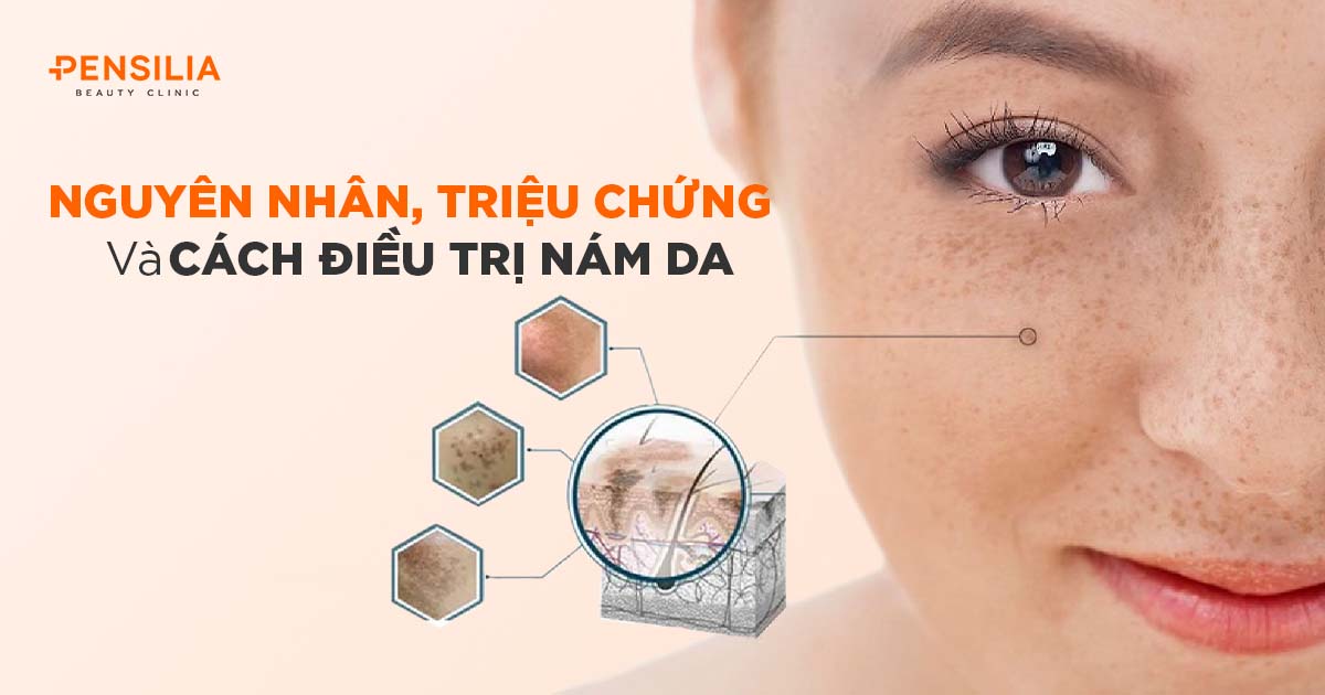 Nguyên nhân, triệu chứng và cách điều trị nám da