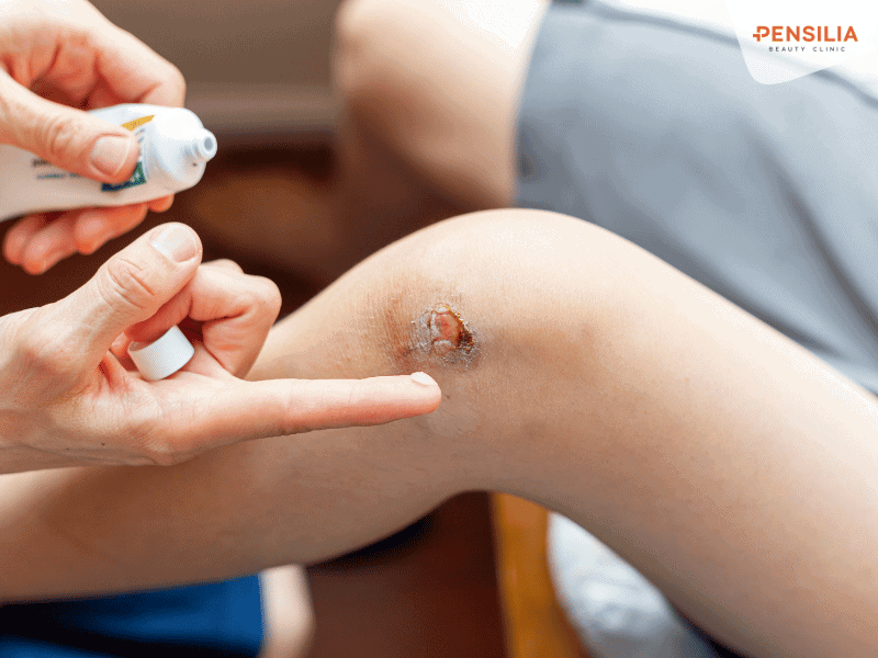 Chăm sóc vết thương đúng cách hạn chế để lại sẹo xấu 