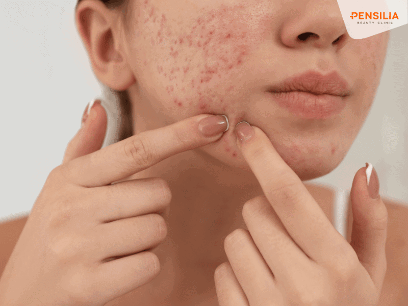 Tránh sẹo và thâm nếu không ngăn ngừa mụn đúng cách