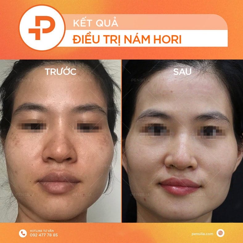 Sau điều trị nám Hori da căng tràn 