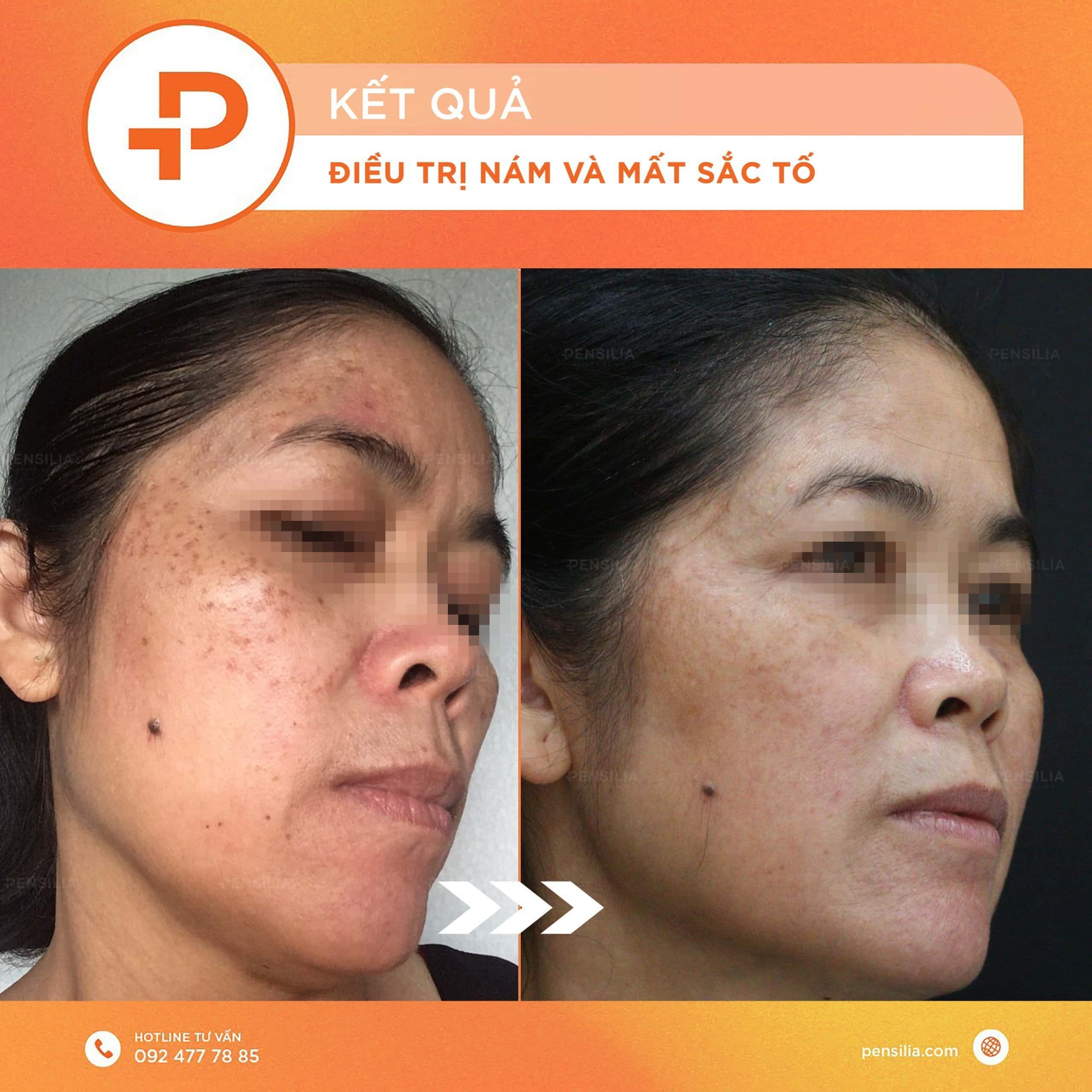 Sau thực hiện điều trị nám, làn da sáng khỏe 