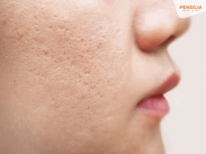 Hiệu quả điều trị sẹo phù thuộc vào nhiều yếu tố