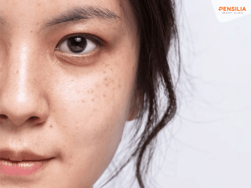 Nám hori gây mất thẩm mỹ và tự tin cho nhiều người