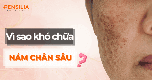 Vì sao điều trị nám chân sâu khó hết?