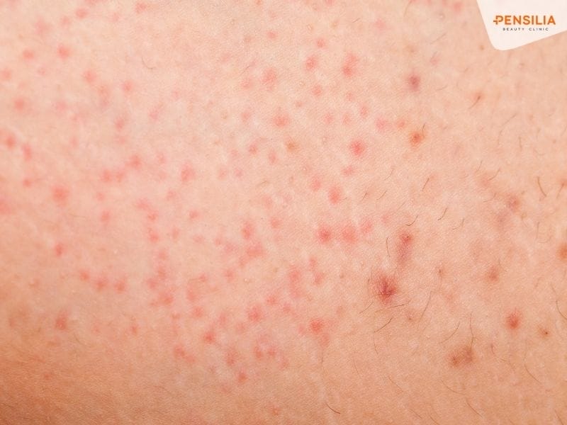 Viêm nang lông nếu không kiểm soát tốt có thể lan rộng