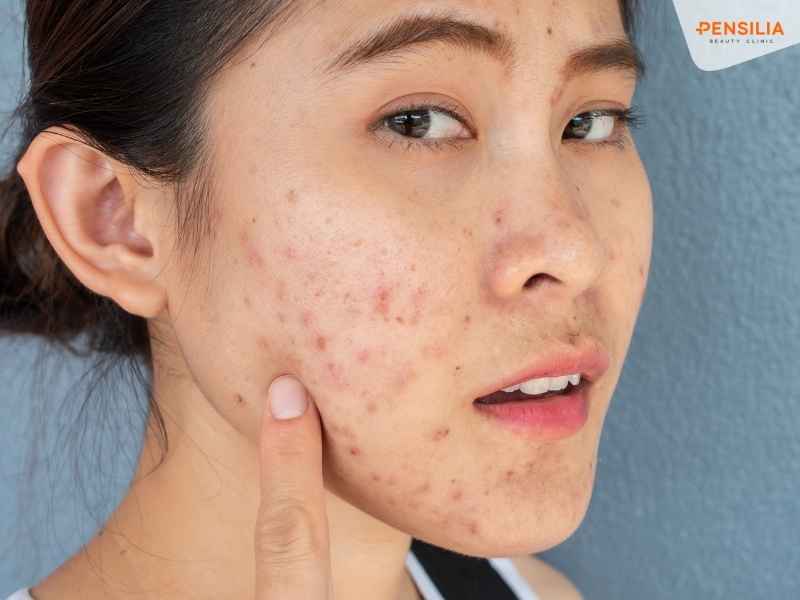 Da xuất hiện mụn nhiều hơn