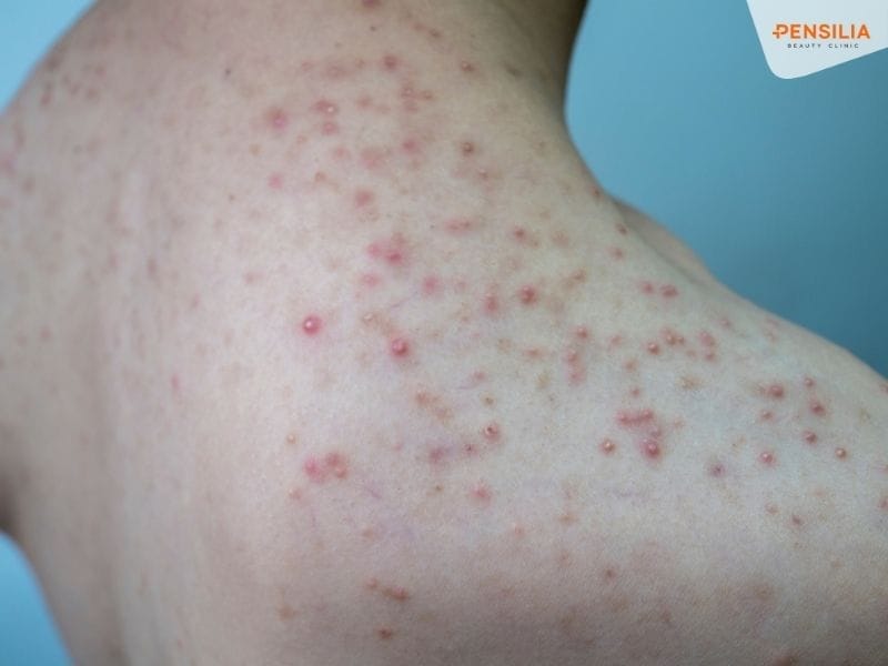 Viêm nang lông là tình trạng viêm nhiễm xảy ra ở các nang lông