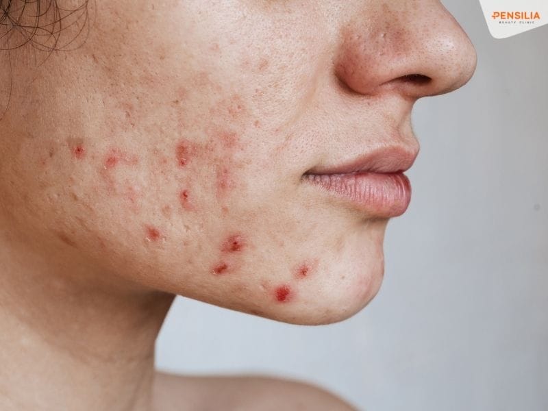 Da thường xuyên nổi mụn