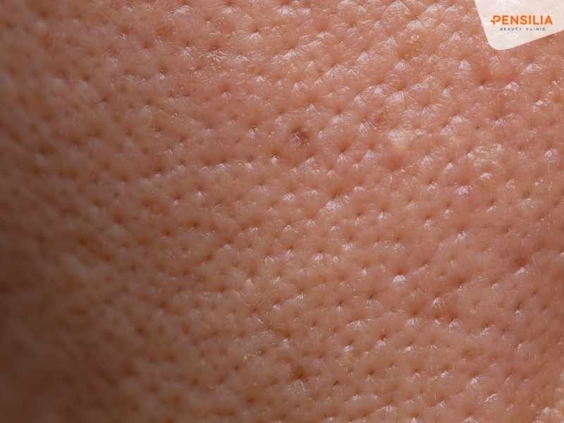 Bụi bẩn từ môi trường làm bít tắc lỗ chân lông