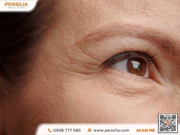 nếp nhăn ở mắt xuất hiện do da mất collagen theo thời gian