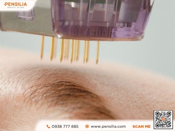 Sylfirm X kích thích tái tạo collagen làm đầy nếp nhăn trán hiệu quả