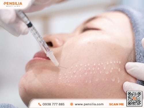 Tiêm PN mesotherapy là phương pháp đưa trực tiếp polynucleotide vào lớp trung bì của da