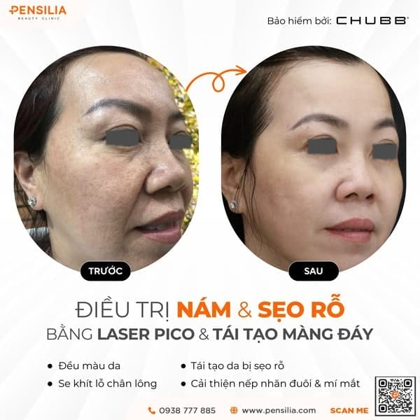 meso nám hiệu quả khi kết hợp với laser nám