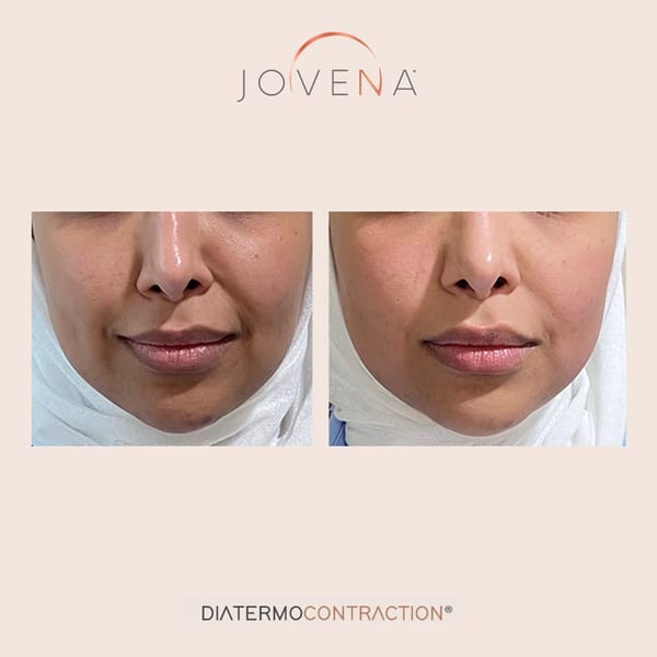kết quả sử dụng công nghệ trẻ hóa da đa tầng Jovena
